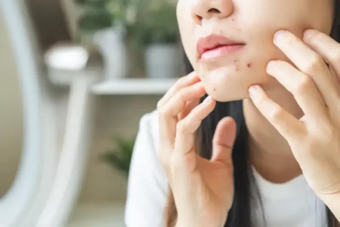 Jangan Asal Pilih, Ini 10 Rekomendasi Facial Wash Acnes