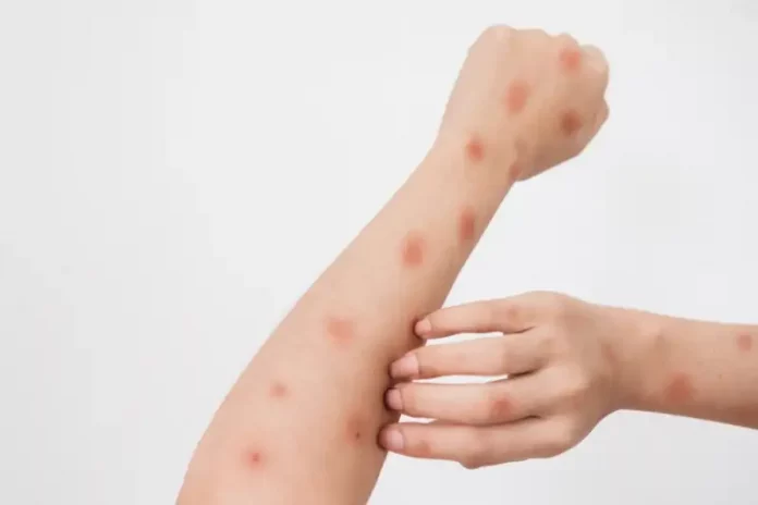 Mengenal MPOX, Penyakit Mirip Cacar Air yang Sudah Menyebar ke Asia MPOX