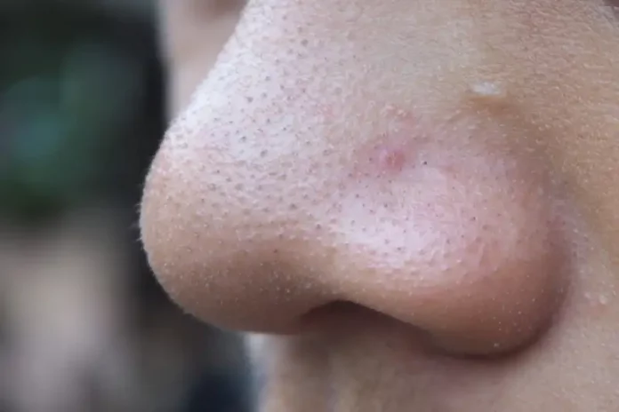 cara menghilangkan komedo di hidung